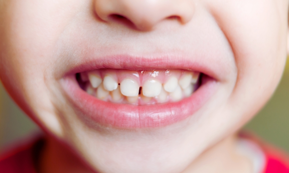 common misconceptions about invisalign for kids